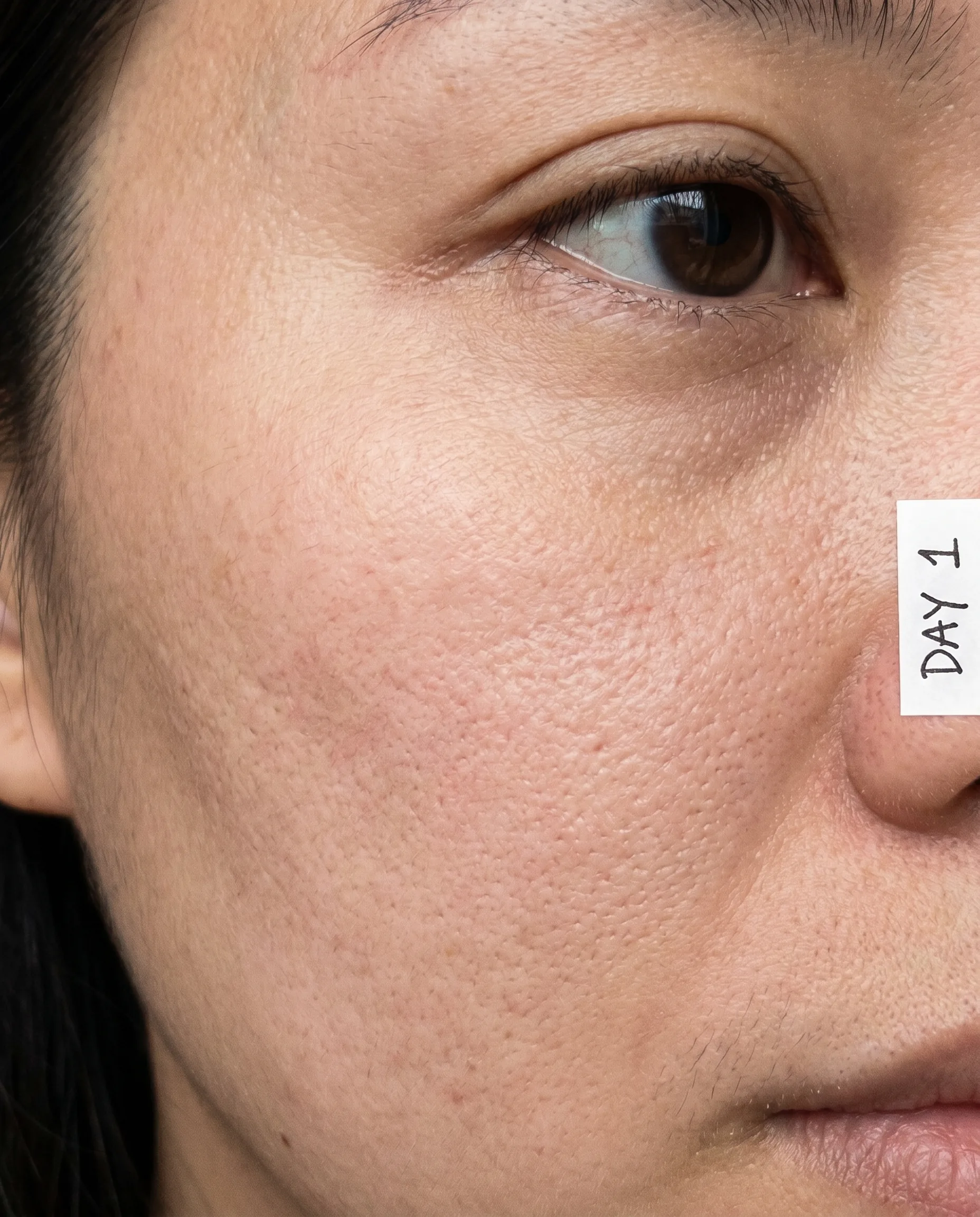 Cheek before - Day 1