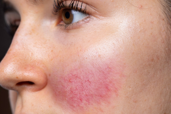  Chống Vi&ecirc;m v&agrave; Giảm Đỏ Da